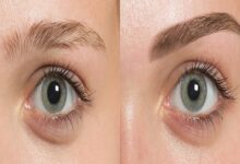 Eyebrow Transplant Chicago