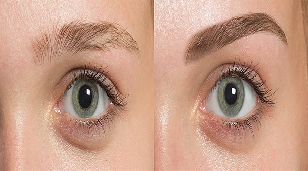 Eyebrow Transplant Chicago