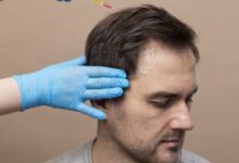 Hair Transplant in Kolkata