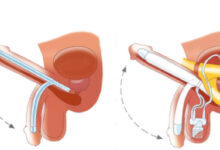 Penile Implant Surgery in India