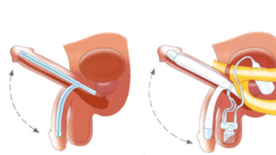 Penile Implant Surgery in India