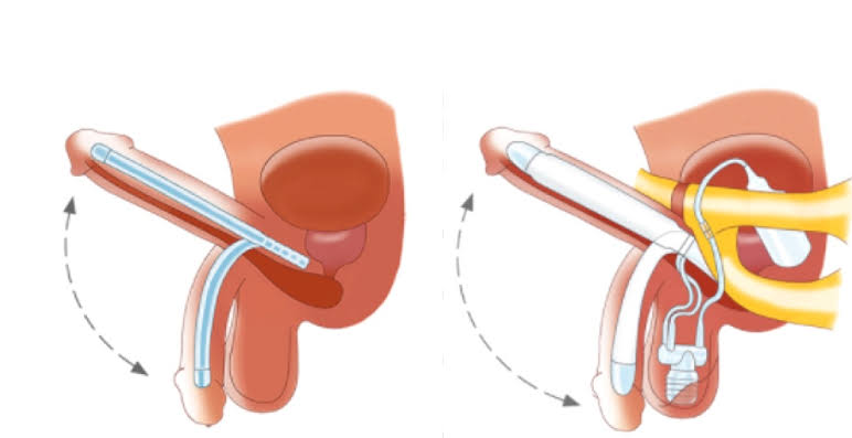 Penile Implant Surgery in India