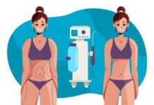 EmSculpt West Loop